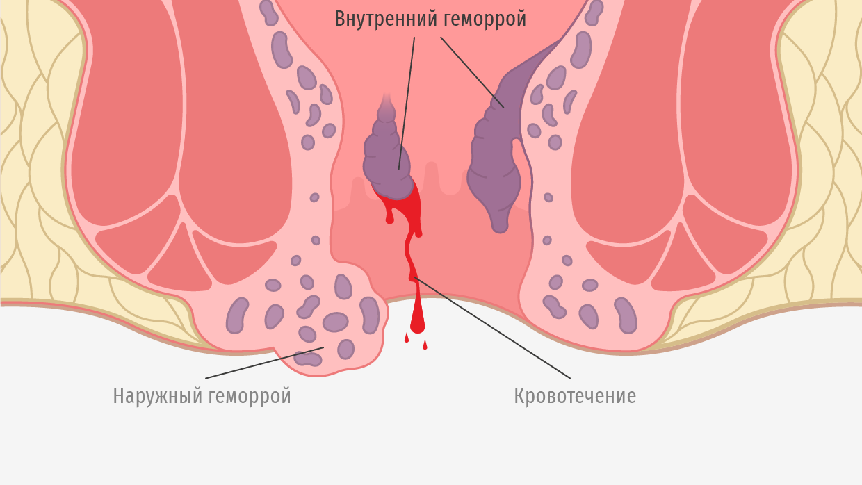 Кровотечение при стуле из прямой кишки